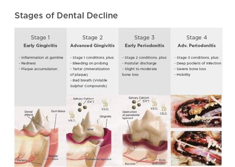 Gum Disease Treatment in South Bradenton, FL .